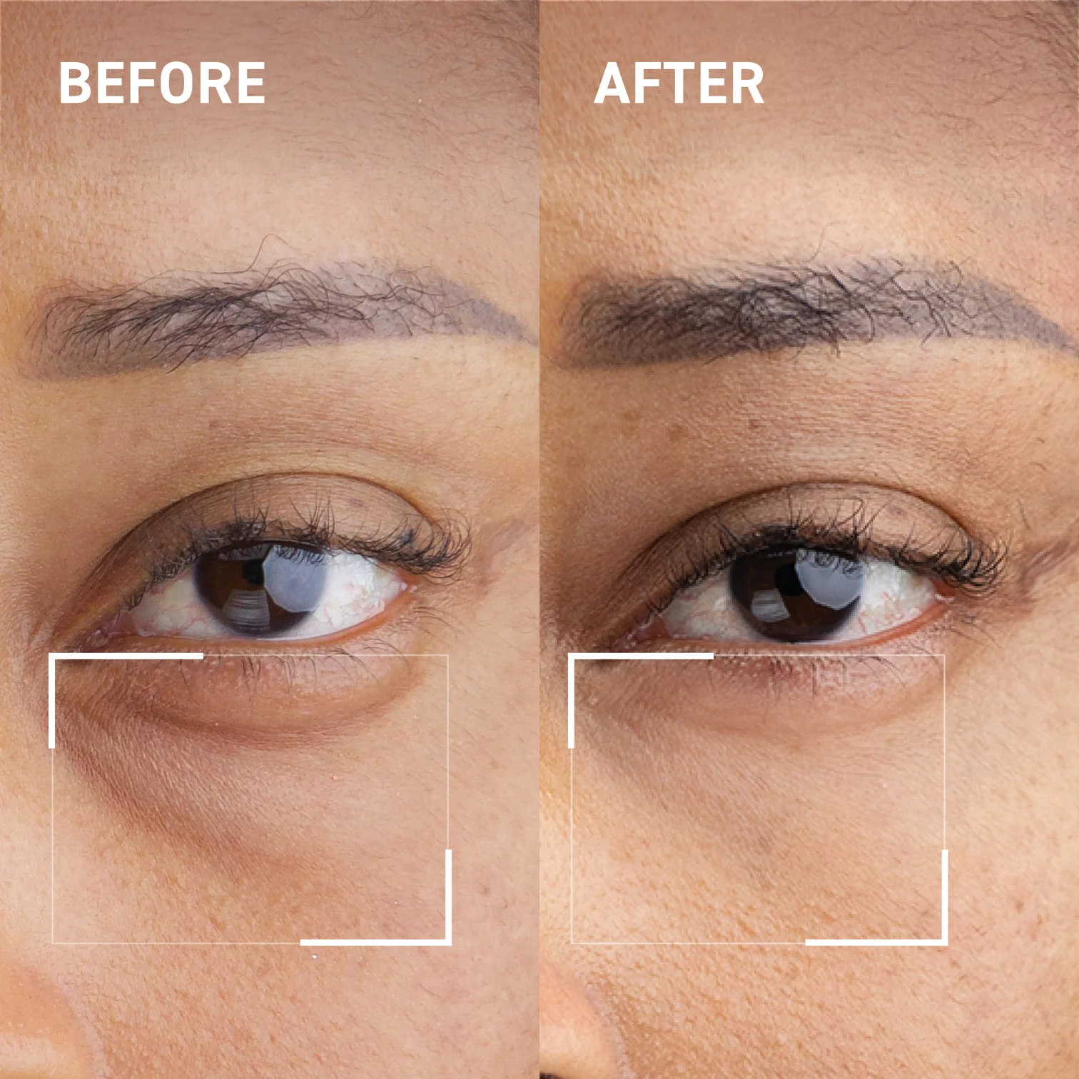 After Muse Eyelift